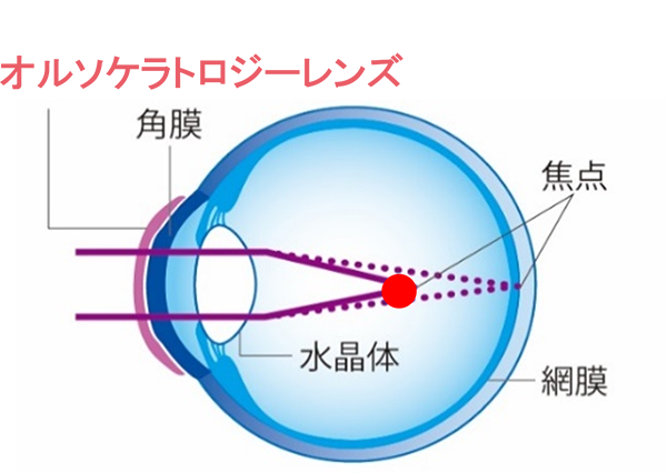 夜：レンズ装用中